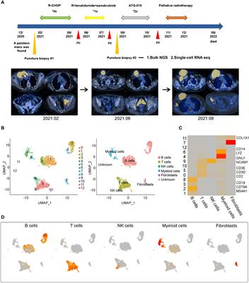 Single-cell transcriptome sequencing provides insight into multiple chemotherapy resistance in a patient with refractory DLBCL: a case report